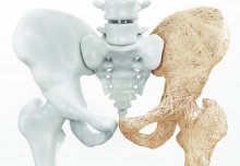 Scientists link 153 new genetic variants to osteoporosis in largest ever study