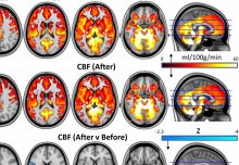 Magic mushrooms may 'reset' the brains of depressed patients