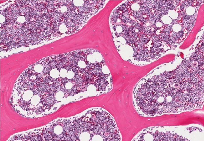 Normal healthy bone marrow depicting blood cells in the absence of leukaemia