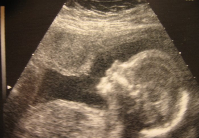 Ultrasound of baby