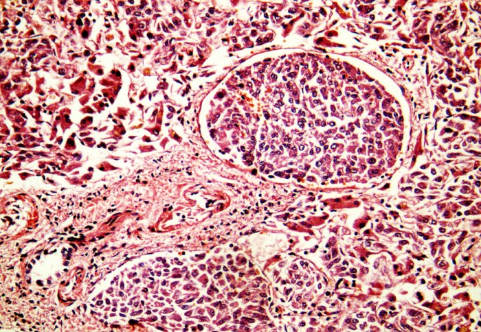 Liver cancer cell