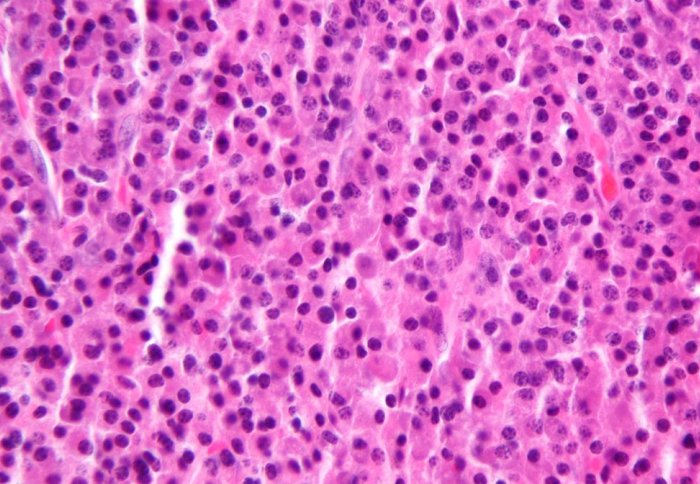 Plasmacytoma