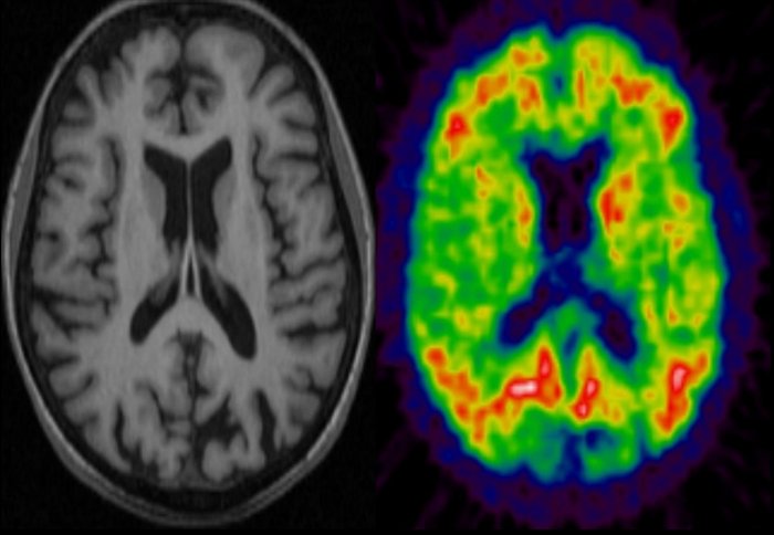 Pet Scan Brain Dementia