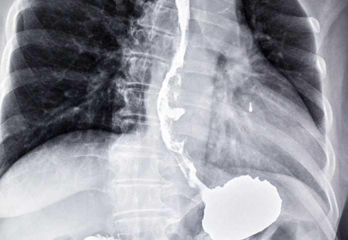 oesophageal cancer