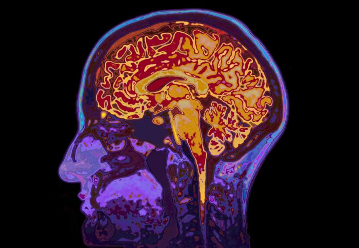 A brain scan, showing a profile cross section of the human head