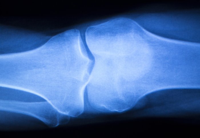 Knee joint meniscus x-ray