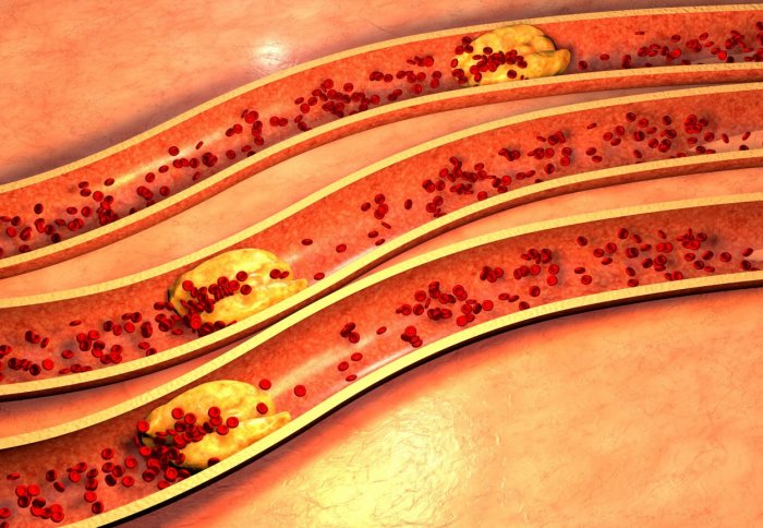 3D image of cholesterol blocking blood flow through blood vessels