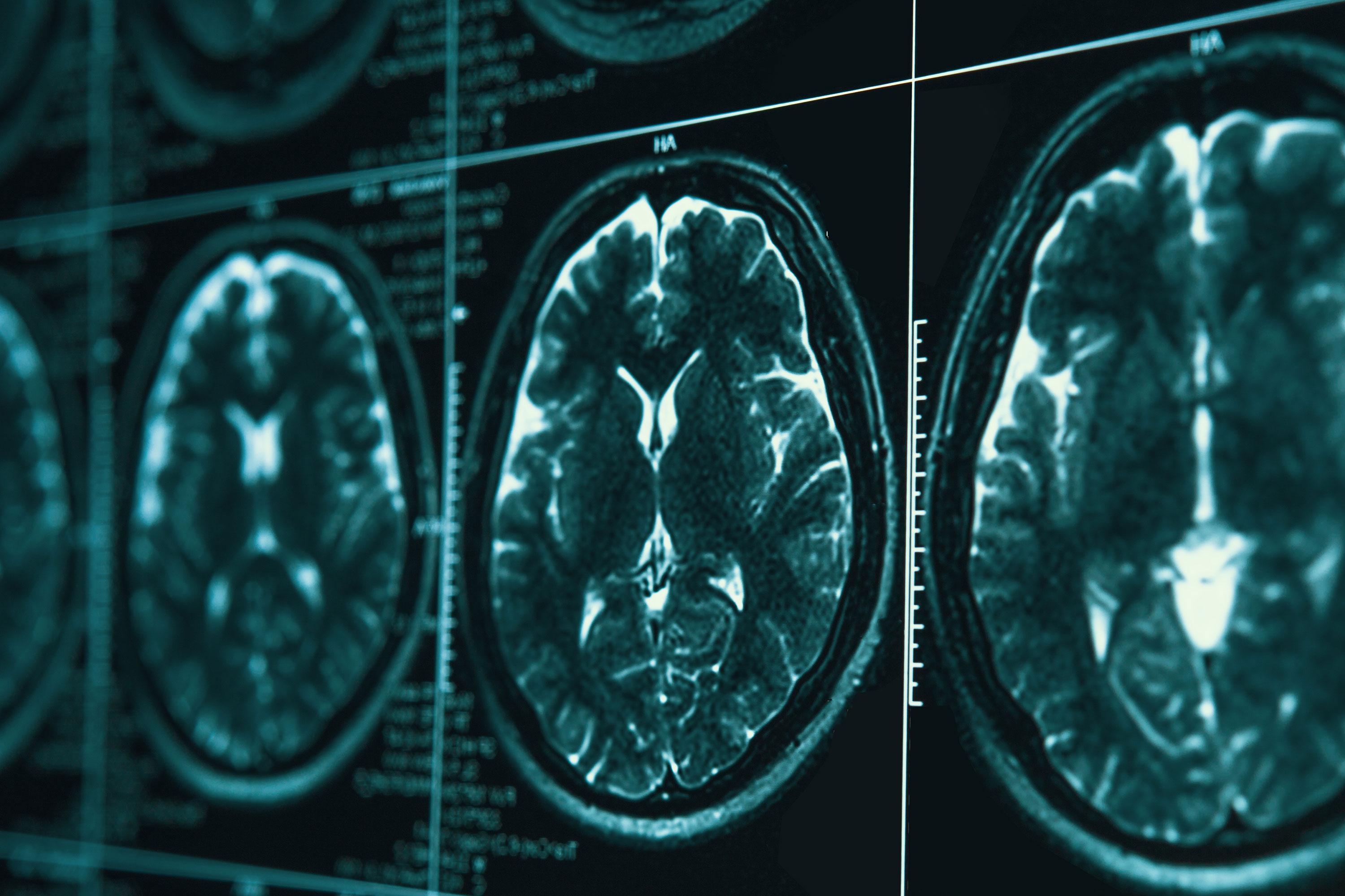 brain scan – dementia