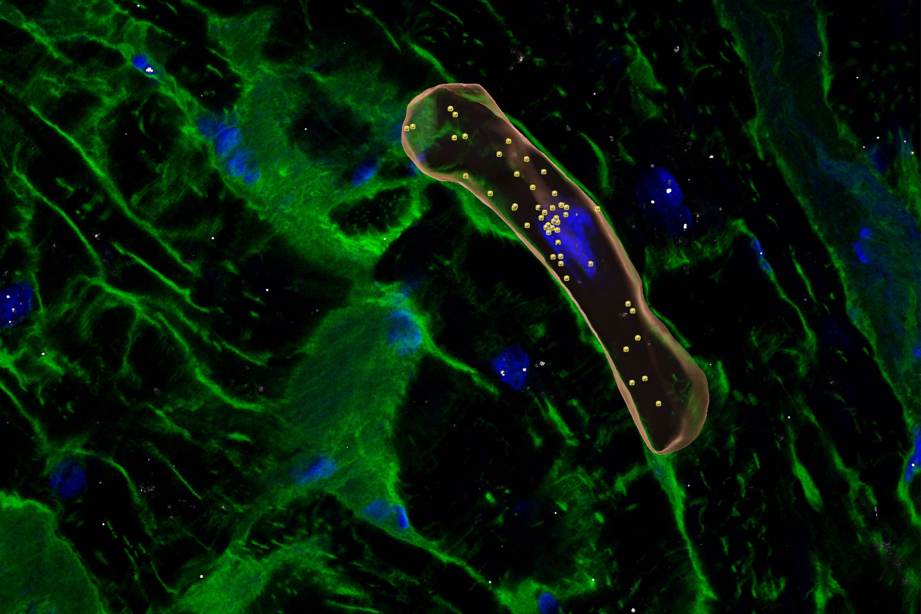 Representative image of a cardiac tissue section from a patient with hypertrophic cardiomyopathy (HCM), showing expression of PRR16 (yellow) within a cardiomyocyte (orange cell). Heightened PRR16 expression in HCM may contribute to enlarged cardiomyocyte Credit: Eric Q. Wei and Martin Beyer, Department of Genetics, Harvard Medical School