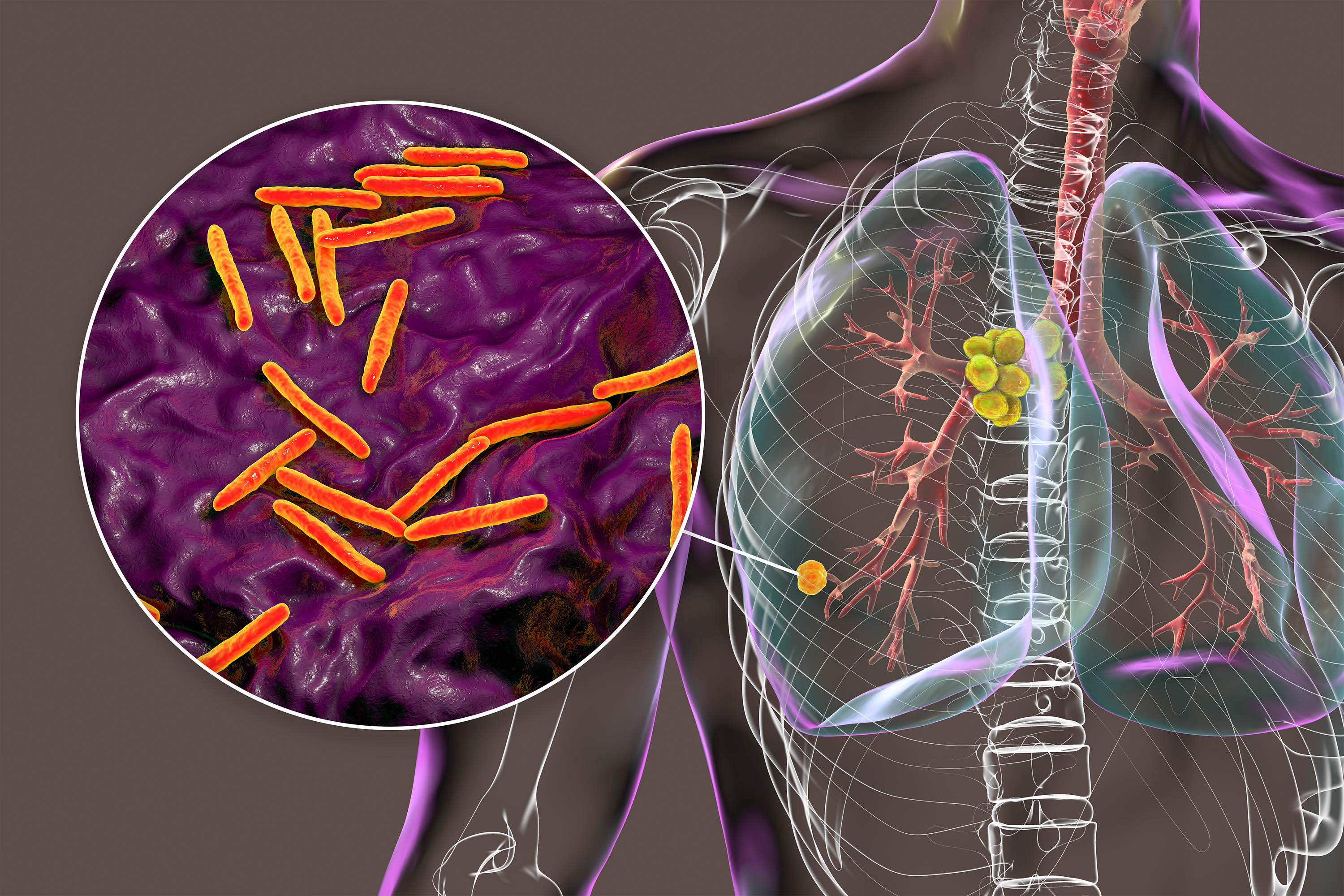 Illustration of primary lung tuberculosis, featuring the Ghon complex and mediastinal lymphadenitis with close-up view of Mycobacterium tuberculosis bacteria