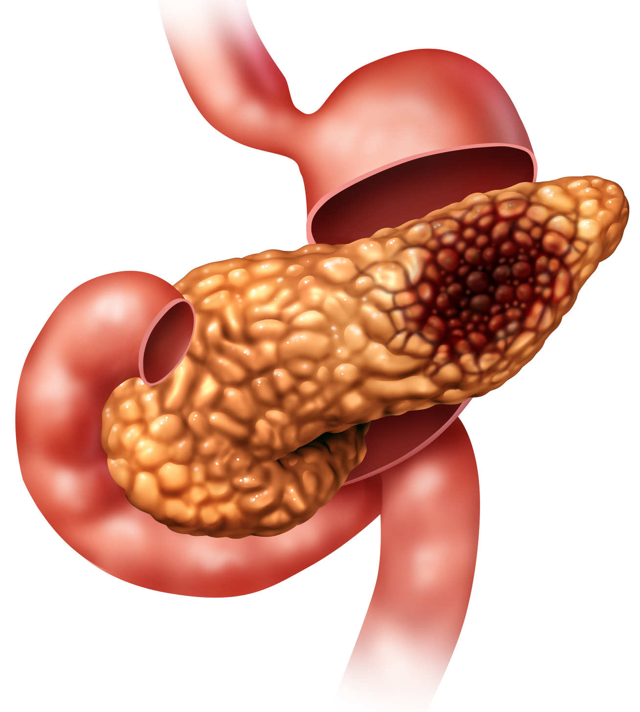 Pancreatic cancer’s very low survival rate has not changed much in 40 years